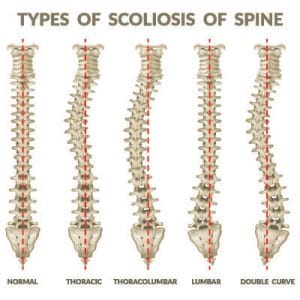 The Facts About Scoliosis